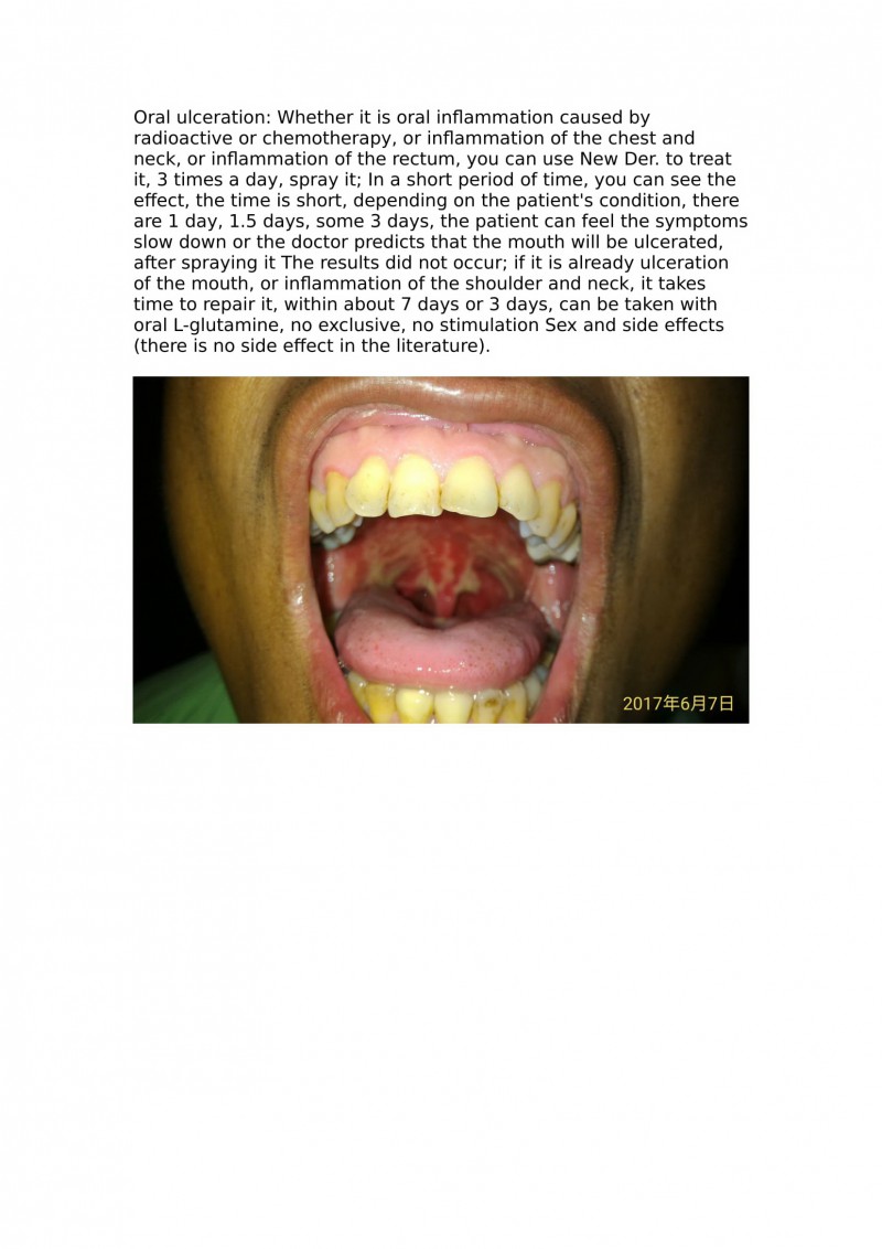 Oral ulceration2-1