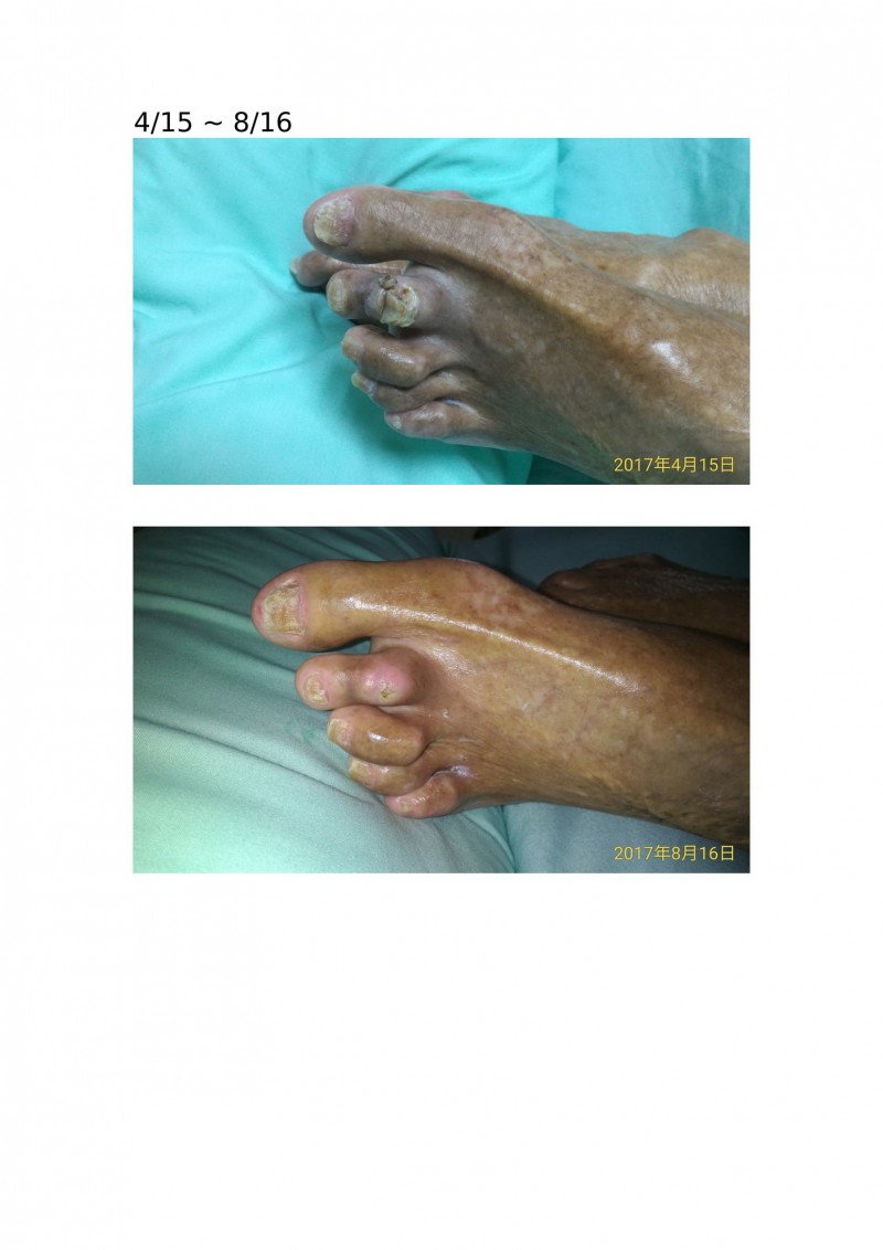 toe wound-1